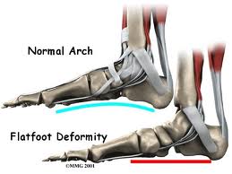 Pes Planus, Flat Foot Deformity, Vancouver