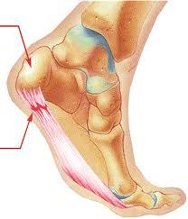 Plantar Fasciitis in Vancouver