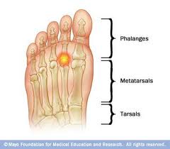 Metatarsal Pain in Vancouver